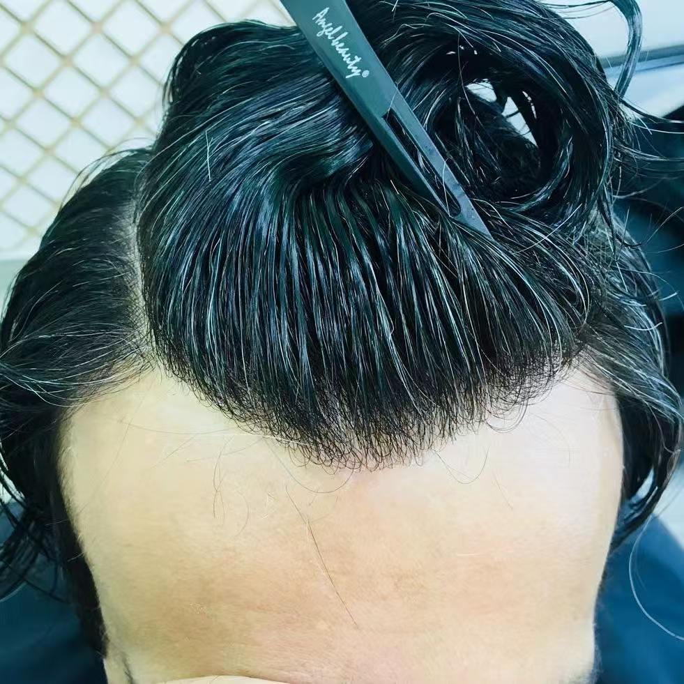 Worn front hairline showing invisible poly skin base blending with natural scalp on real head
